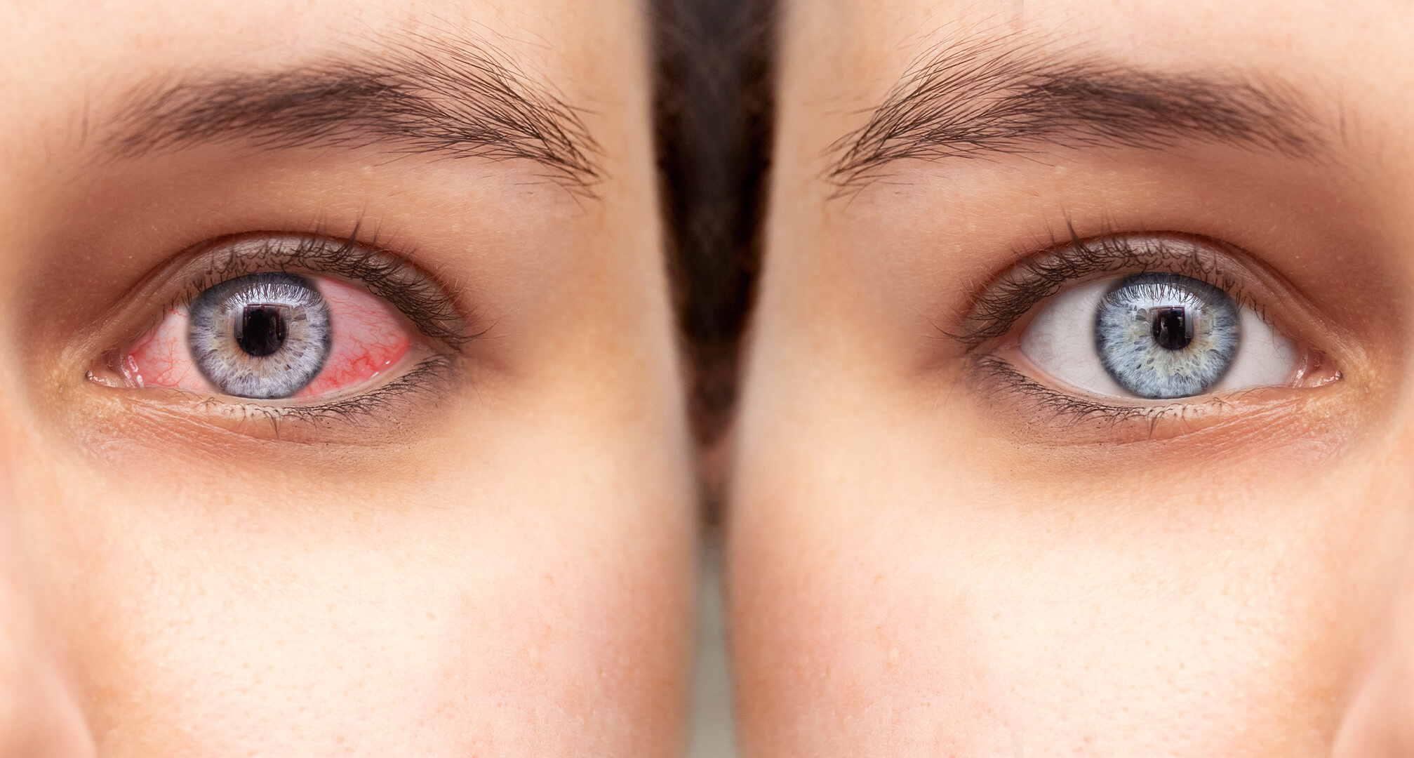 κοντινό πλάνο δύο ματιών δίπλα-δίπλα, ένα κόκκινο μάτι με ξηροφθαλμία στα αριστερά και ένα υγιές μάτι στα δεξιά