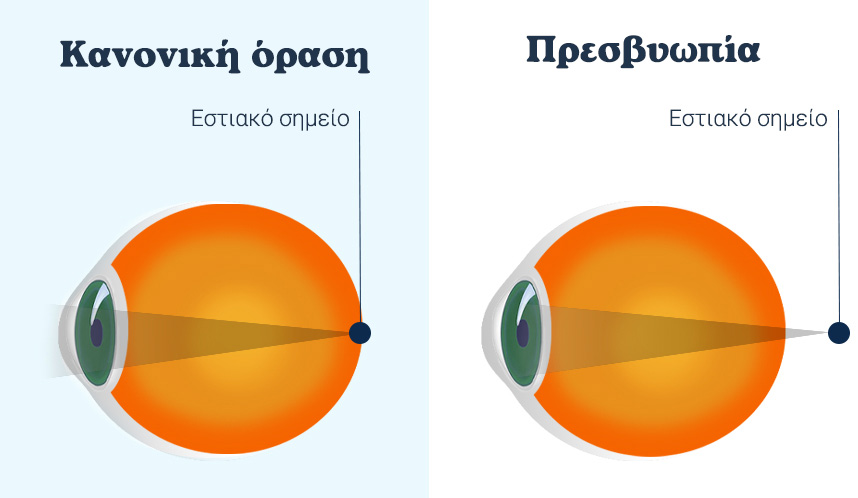εικόνα εστιακού σημείου σε φυσιολογικό μάτι και σε μάτι με πρεσβυωπία