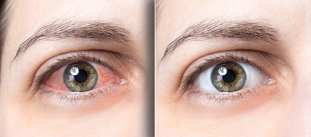 Red eyes vs. clear eyes