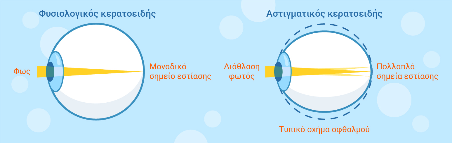 φυσιολογικός και αστιγματικός κερατοειδής